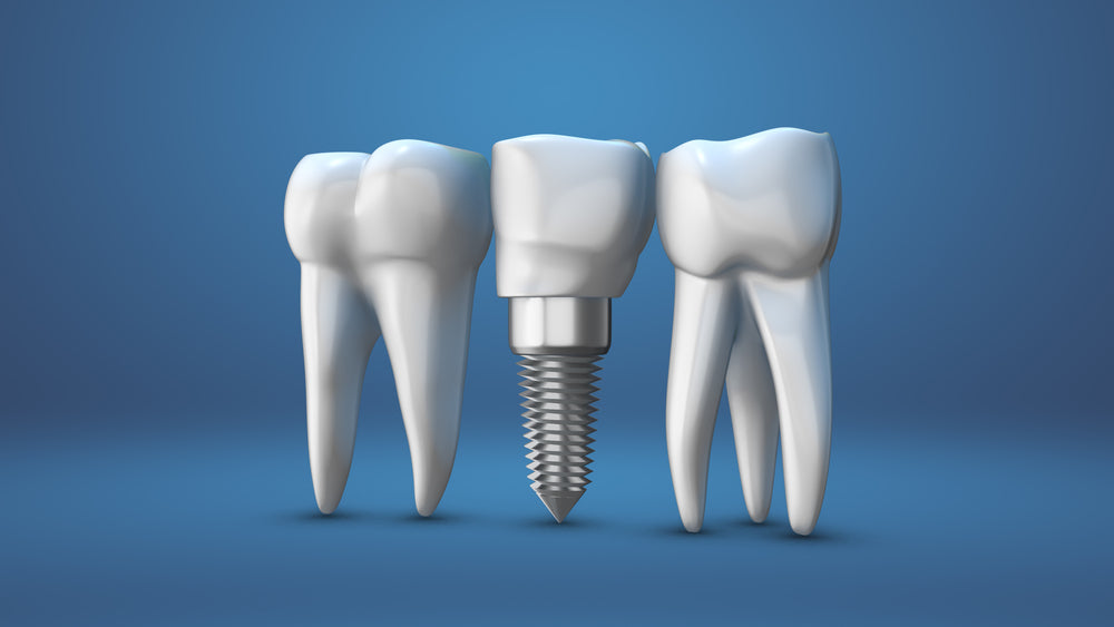 dental implant