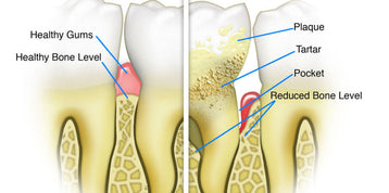 PERIODONTAL DISEASE AND HEALTHY GUMS